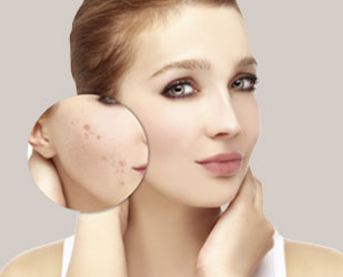 Why Choose Your Esthetician for Acne Treatment?