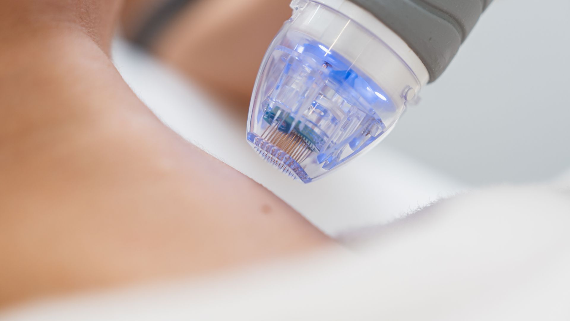 Microneedling