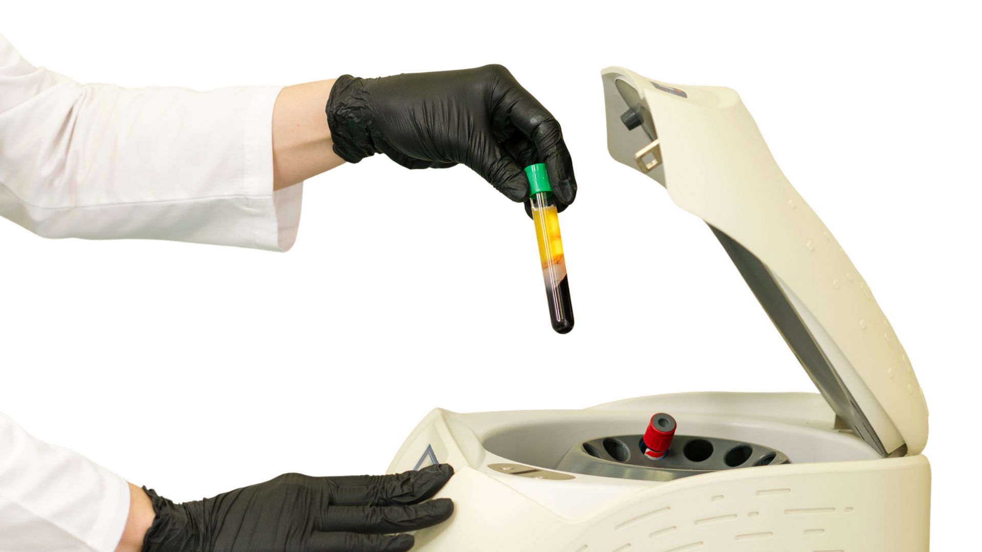 PRP Platelet Rich Plasma